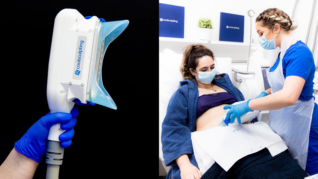Is CoolSculpting worth it? - Before and After Results
