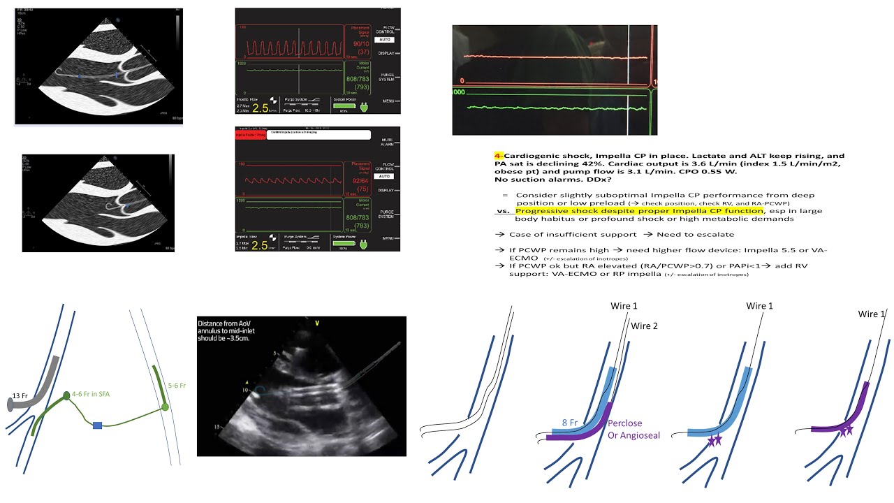 Impella: concepts, troubleshooting scenarios, weaning, sheath management- Elias Hanna