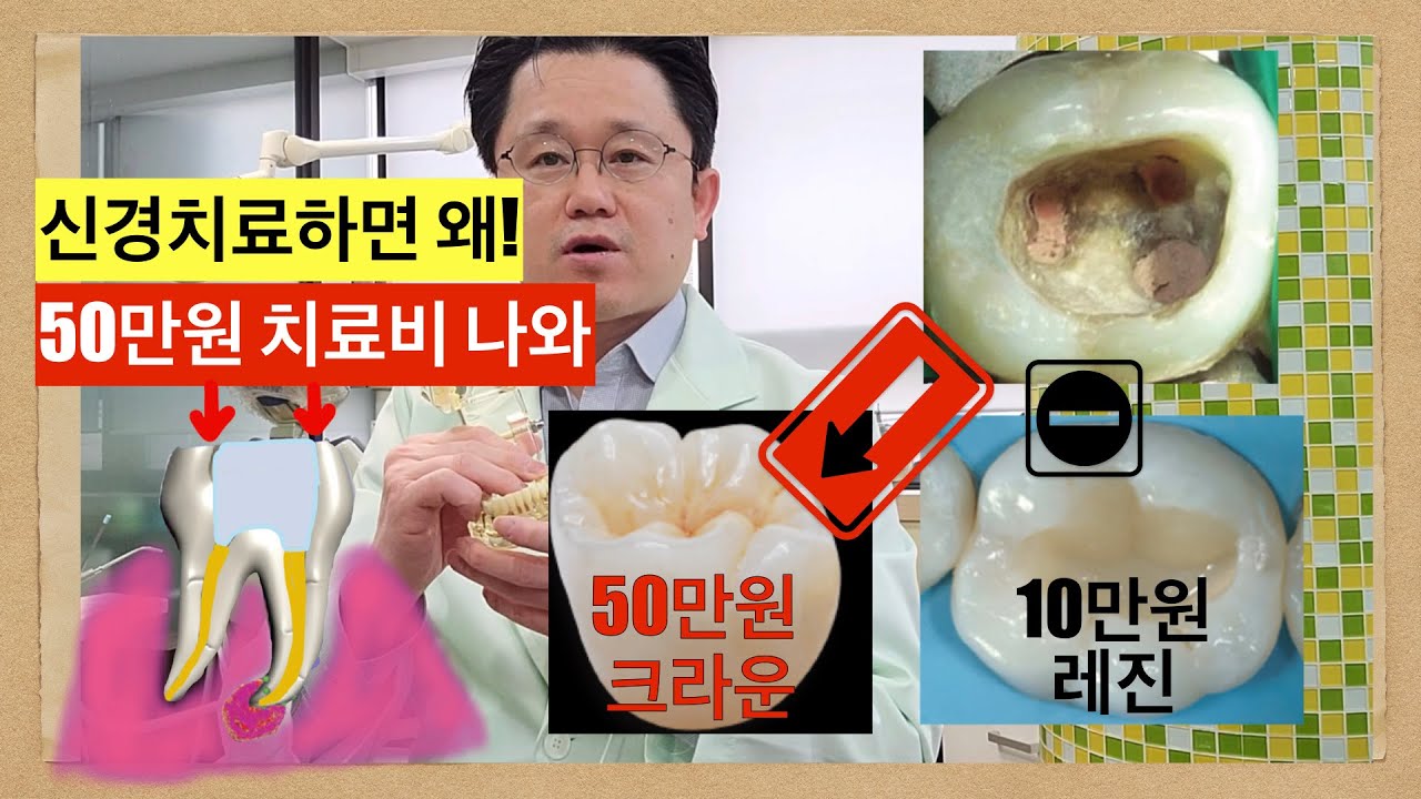 신경치료후 레진대신  크라운만 씌우는  2가지 이유