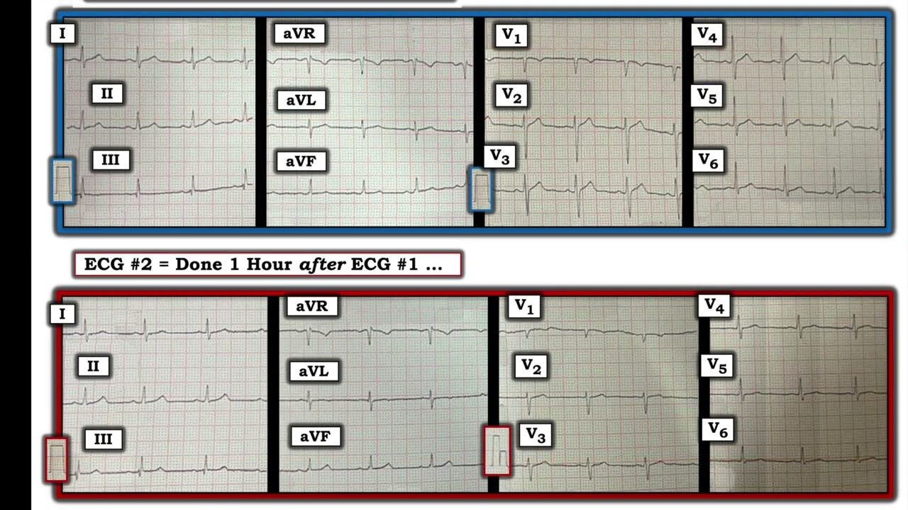 ECG Video Blog #407 &mdash;&nbsp;Why Did the Patient Die? (12-1.1-2023)