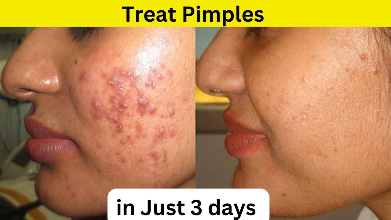 How to Treat Pimples and Acne in Just 3 Days | Pimples Treatment | Cure Acne Fast 