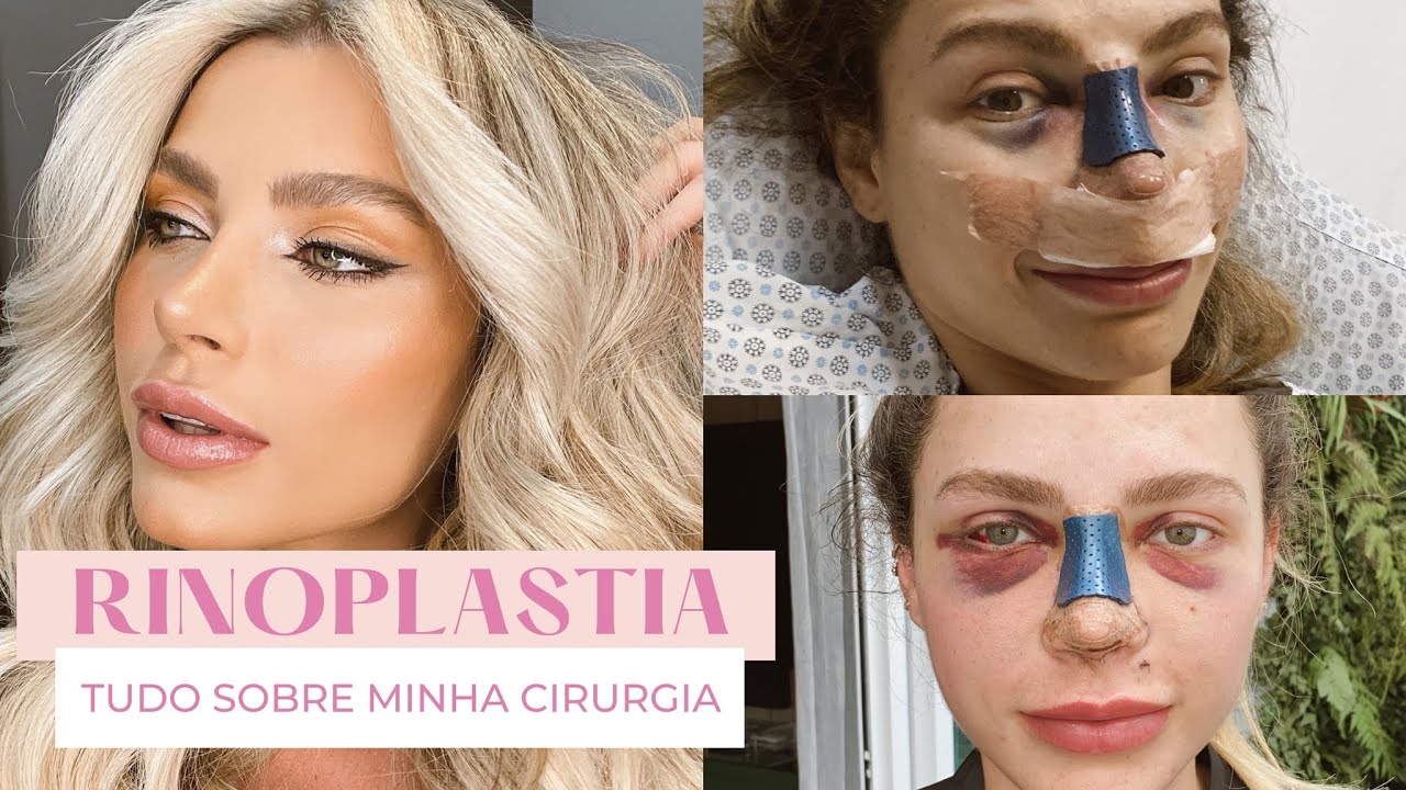 FIZ RINOPLASTIA | Mamá Castilho