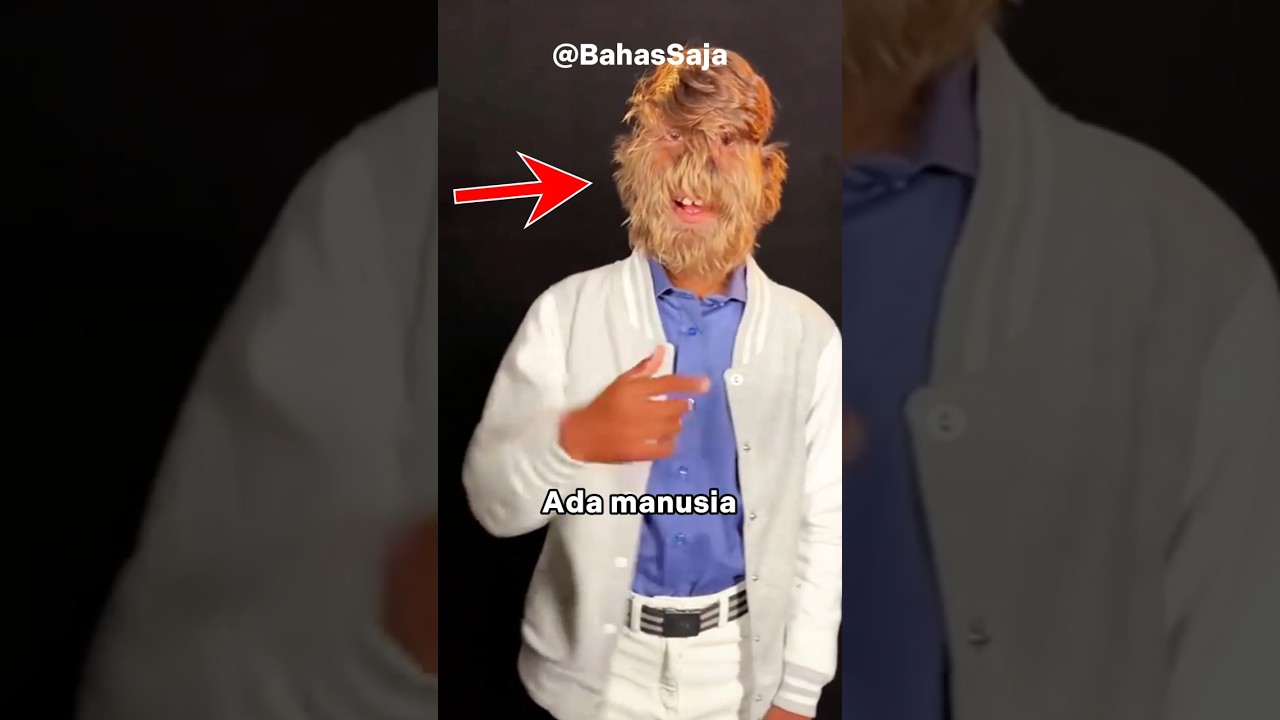 Penyakit Langka ini Membuat Manusia Terlihat Seperti Werewolf 😱