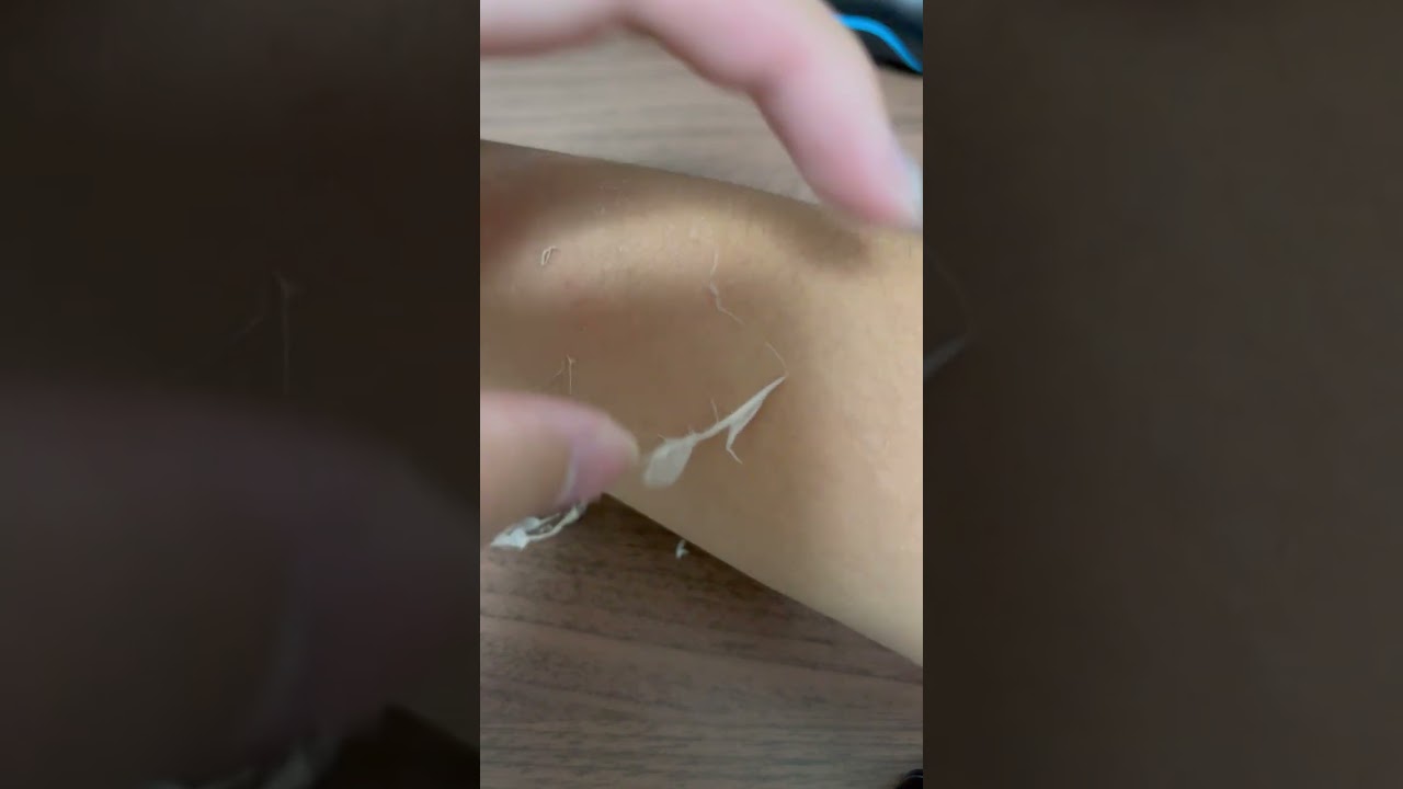 日焼けの皮むき
