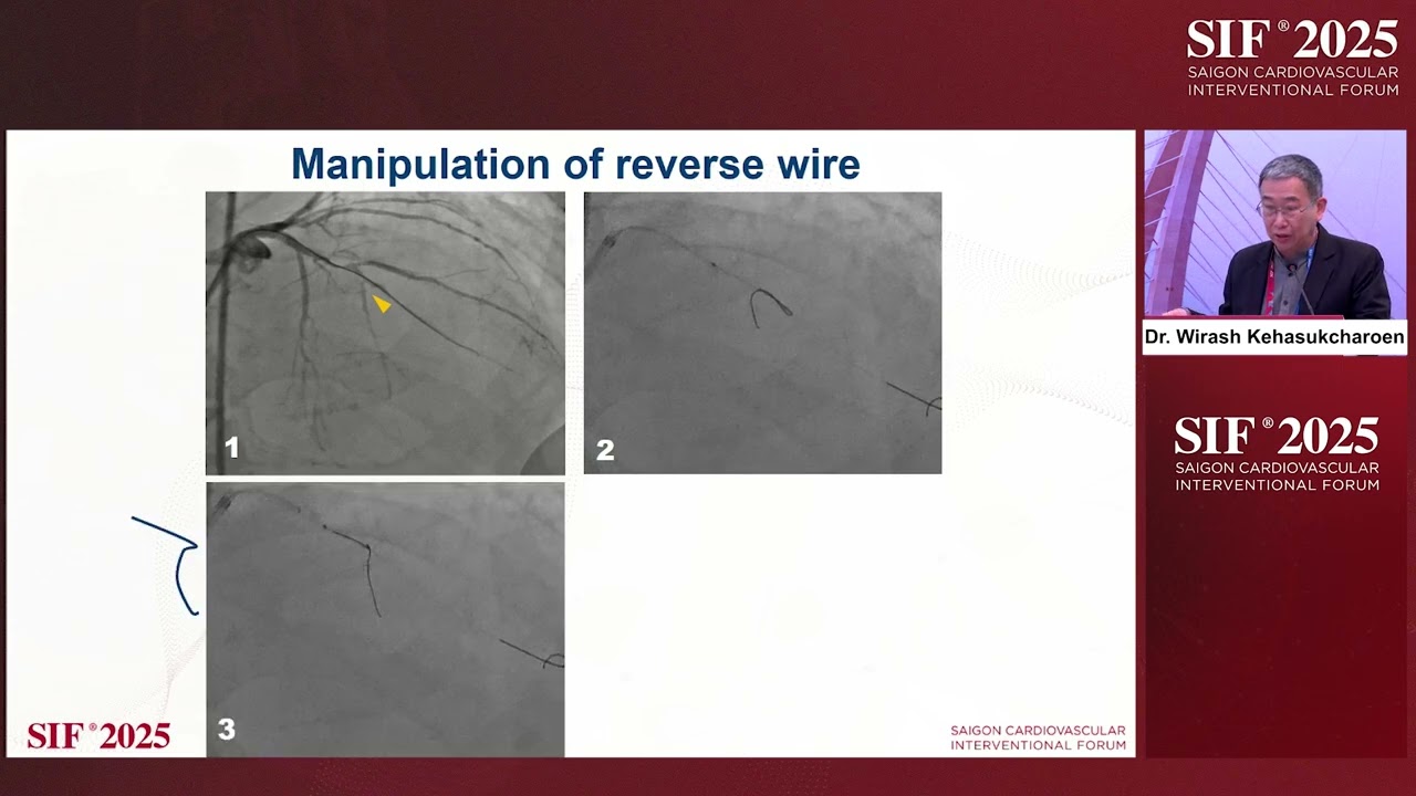Room C- C9- Tips and tricks for complex bifurcation PCI with cases demonstrations