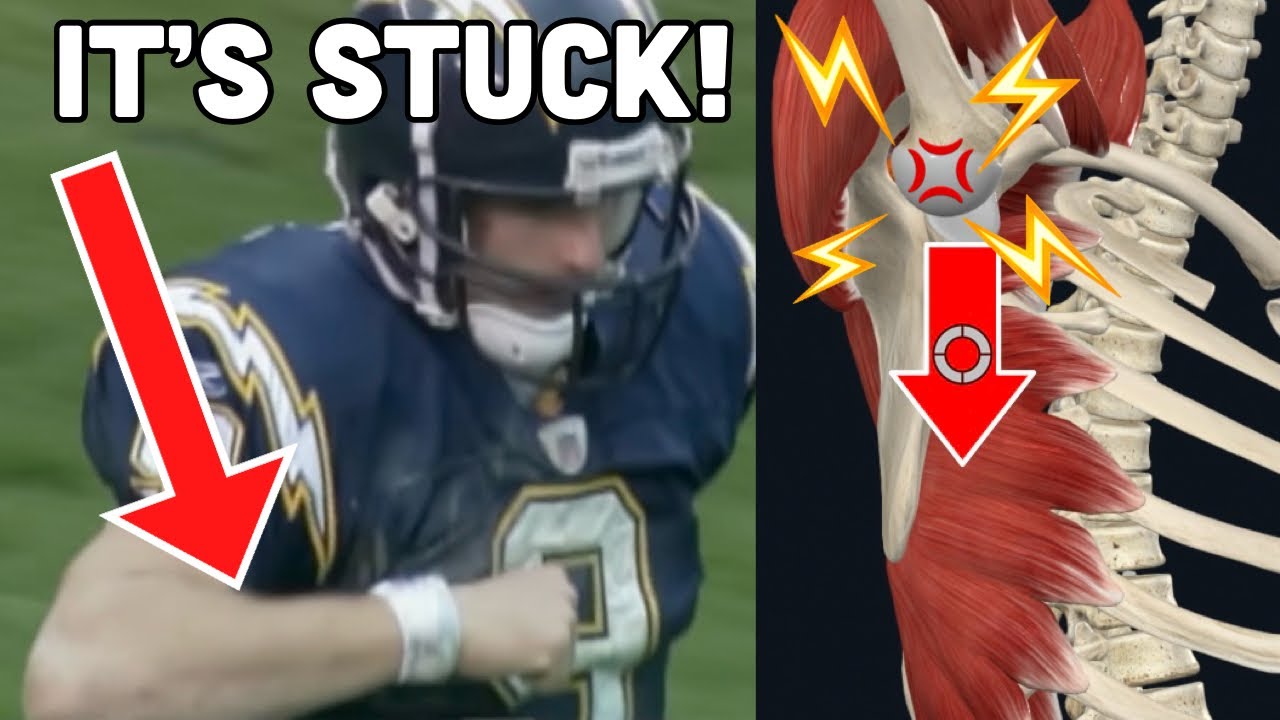 WORST NFL SHOULDER INJURY? Doctor Explains why DREW BREES can't THROW
