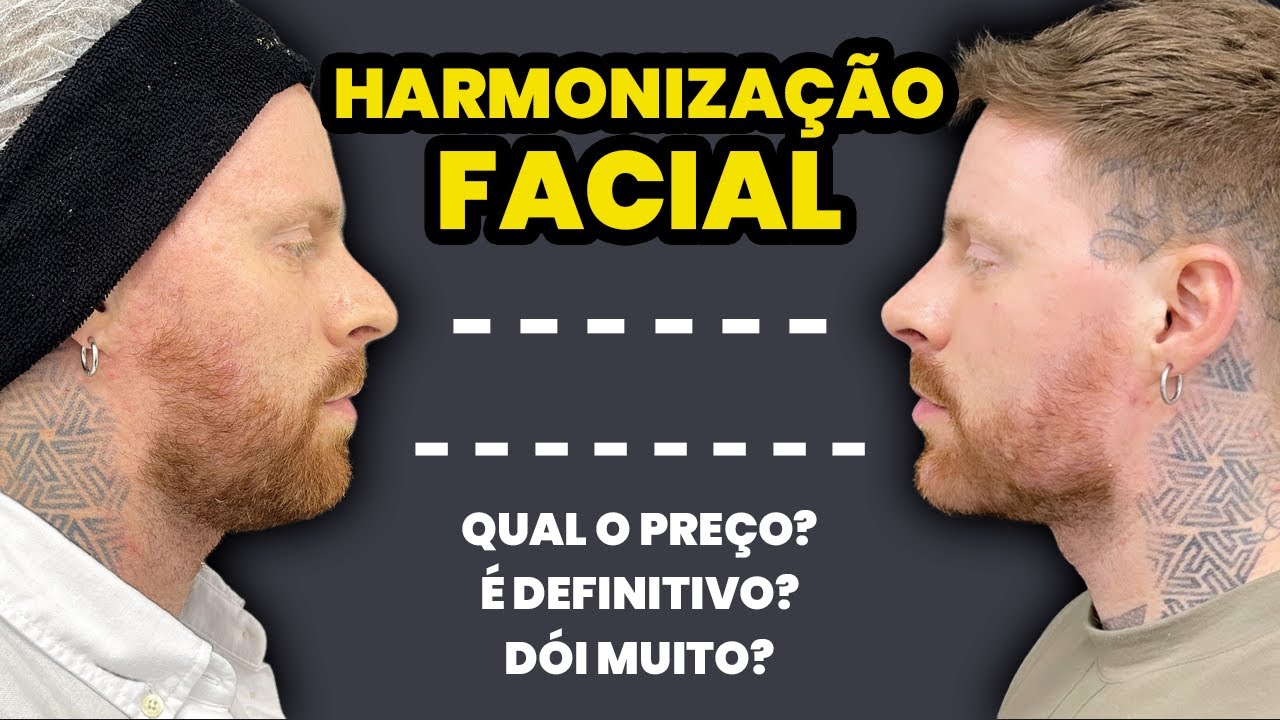 HARMONIZAÇÃO FACIAL MASCULINA: Antes e Depois - Respondendo Dúvidas sobre o Procedimento