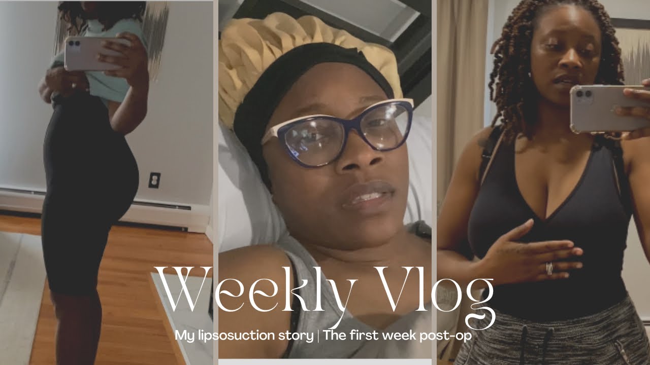 I GOT PLASTIC SURGERY • 1st week post-op • Elite Airsculpt body contouring - Weekly Vlog