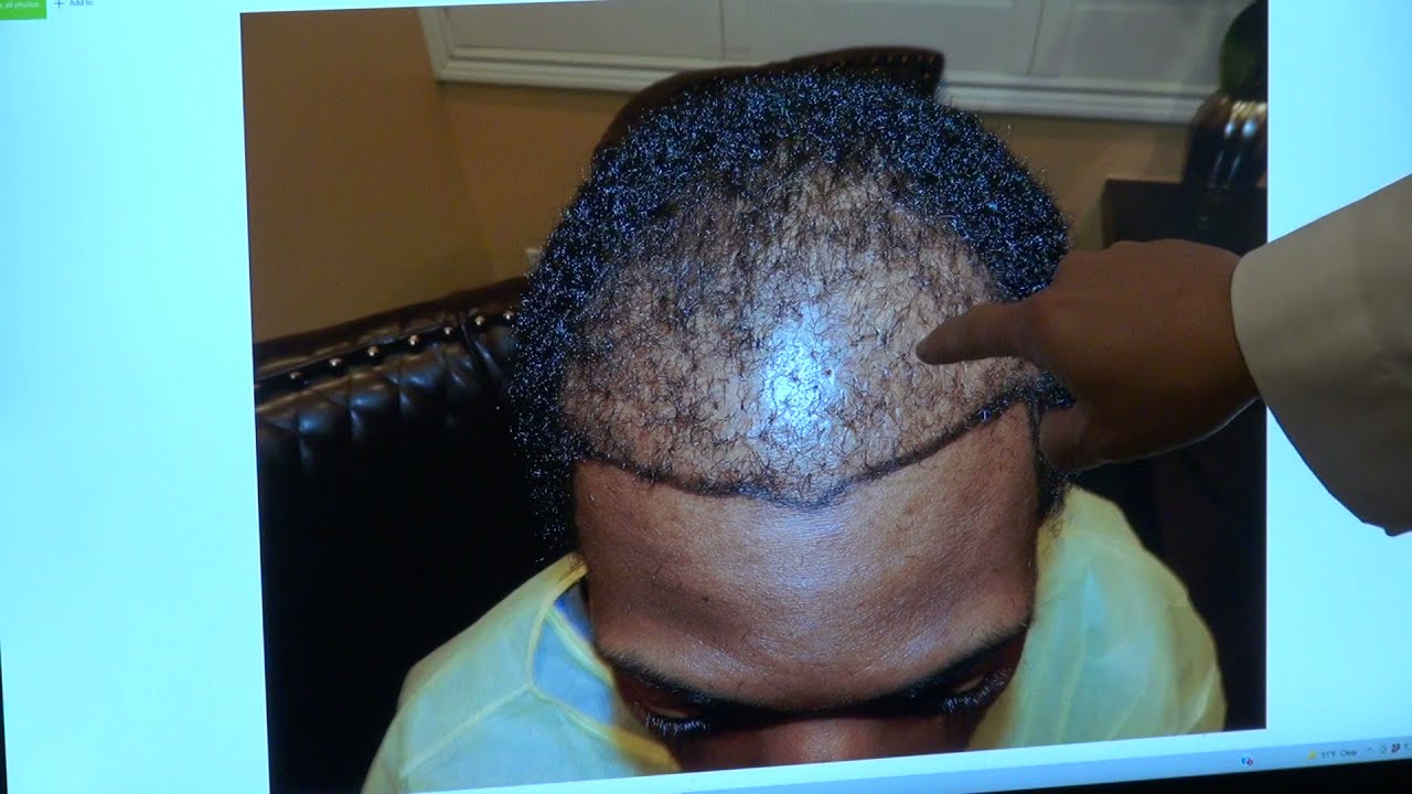 Afro Hair Transplant (3,500 Grafts)- Black Curly Hair | Men's Hair Transformation (Before and After)