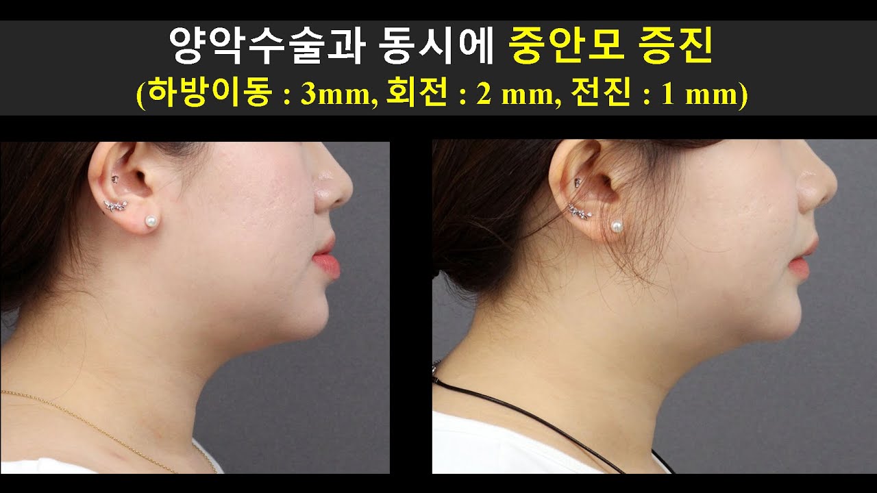 양악수술과 동시에 중안모 증진(하방:3 mm, 회전:2 mm,전진:1 mm ) Midfacial Augmentation with Orthognathic Surgery