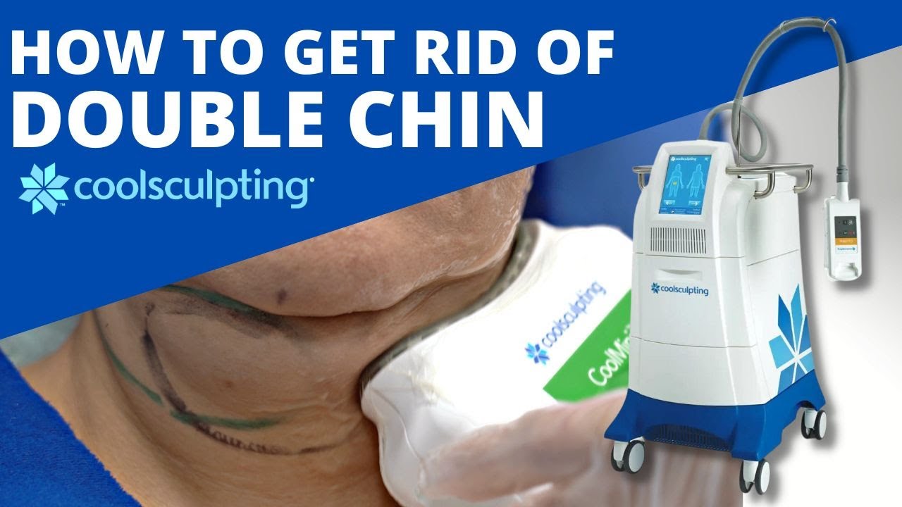 Double Chin Fat Reduction using CoolSculpting.