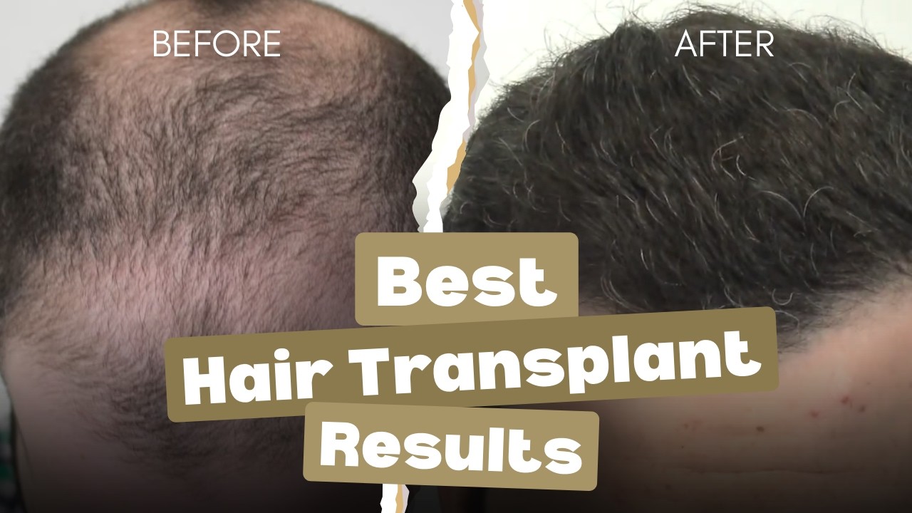 FUT vs FUE Pros and Cons - 2557 FUE Grafts Results Dr. Rahal