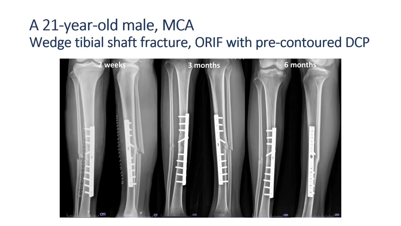 Dynamisation of tibial plate in non union tibia - A case report