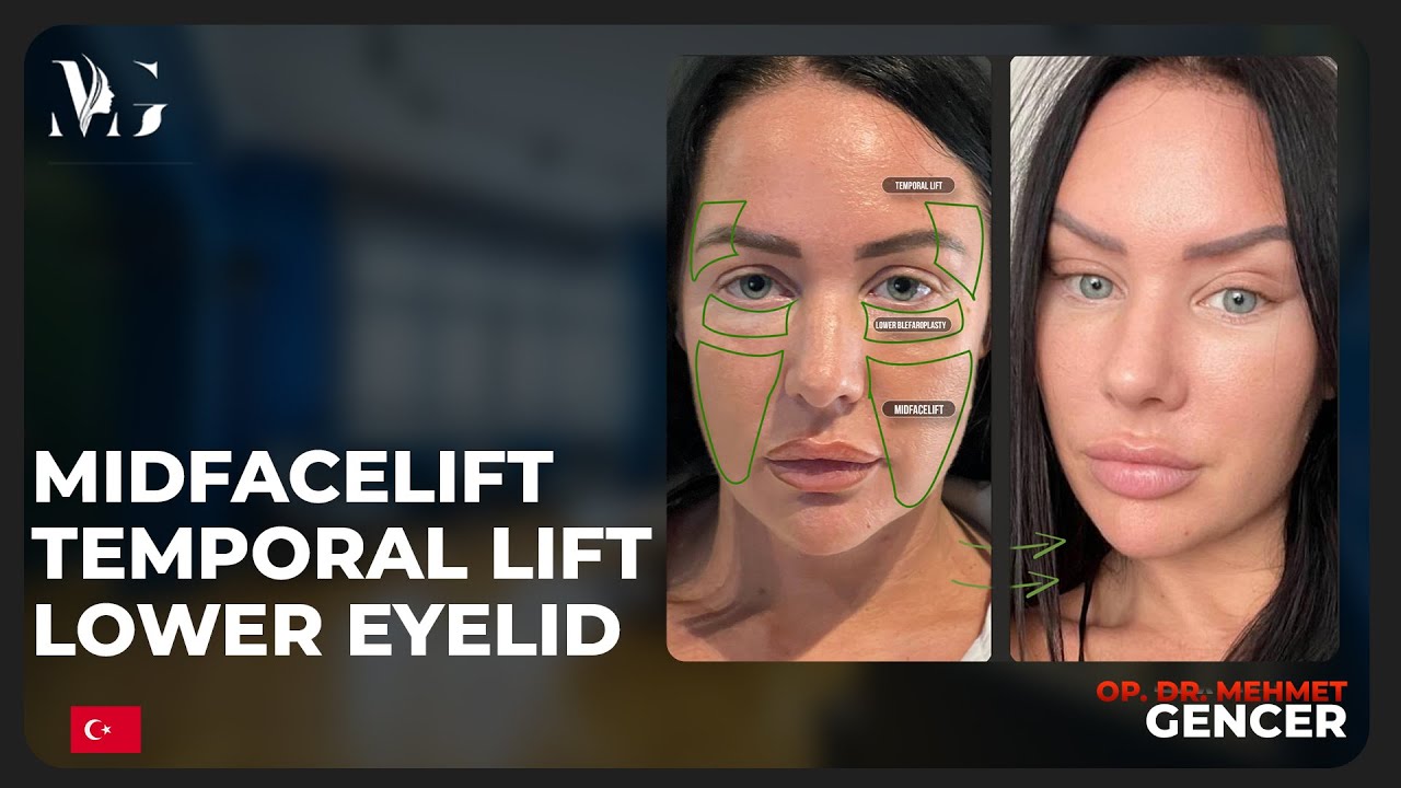 Midfacelift + Şakak Germe + Alt göz kapağı estetiği nedir ? Nasıl yapıyorum ?