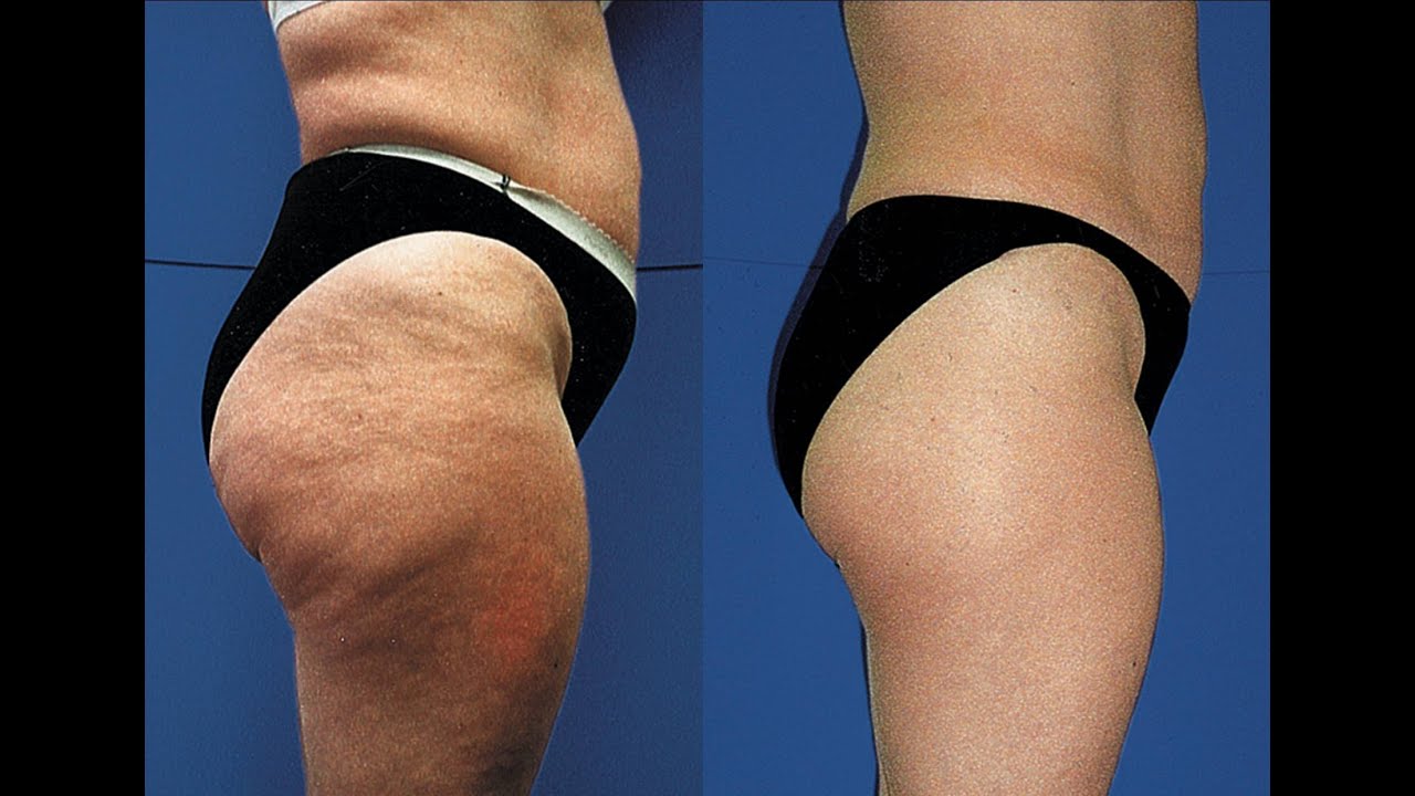 DermTV - What is Cellulite [DermTV.com Epi #263]