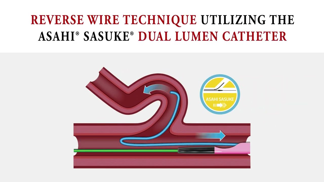 Dual-Lumen Catheterization: Utilizing the Reverse Wire Method