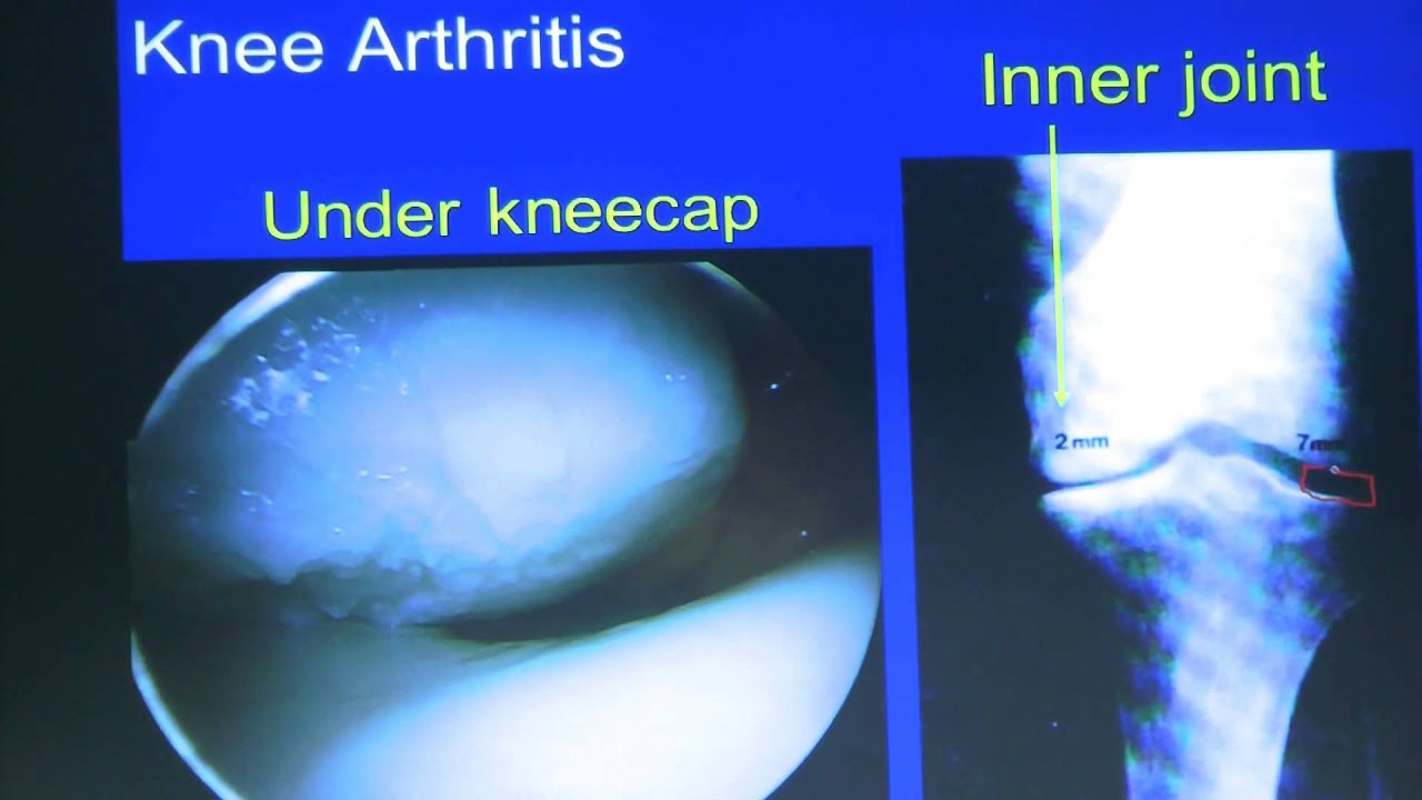 Orthopedic Surgeon Talks Osteoarthritis