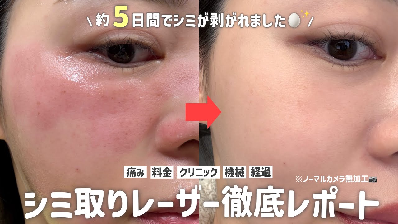 【シミ取り🏥】施術内容〜剥がれるまでの経過を全部見せ😤気になる機械や料金も公開◎