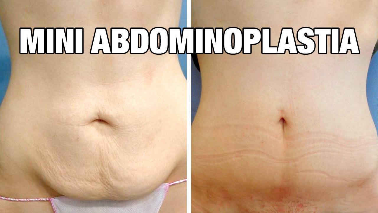 Mini Abdominoplastia antes y después | Testimonio Cristina