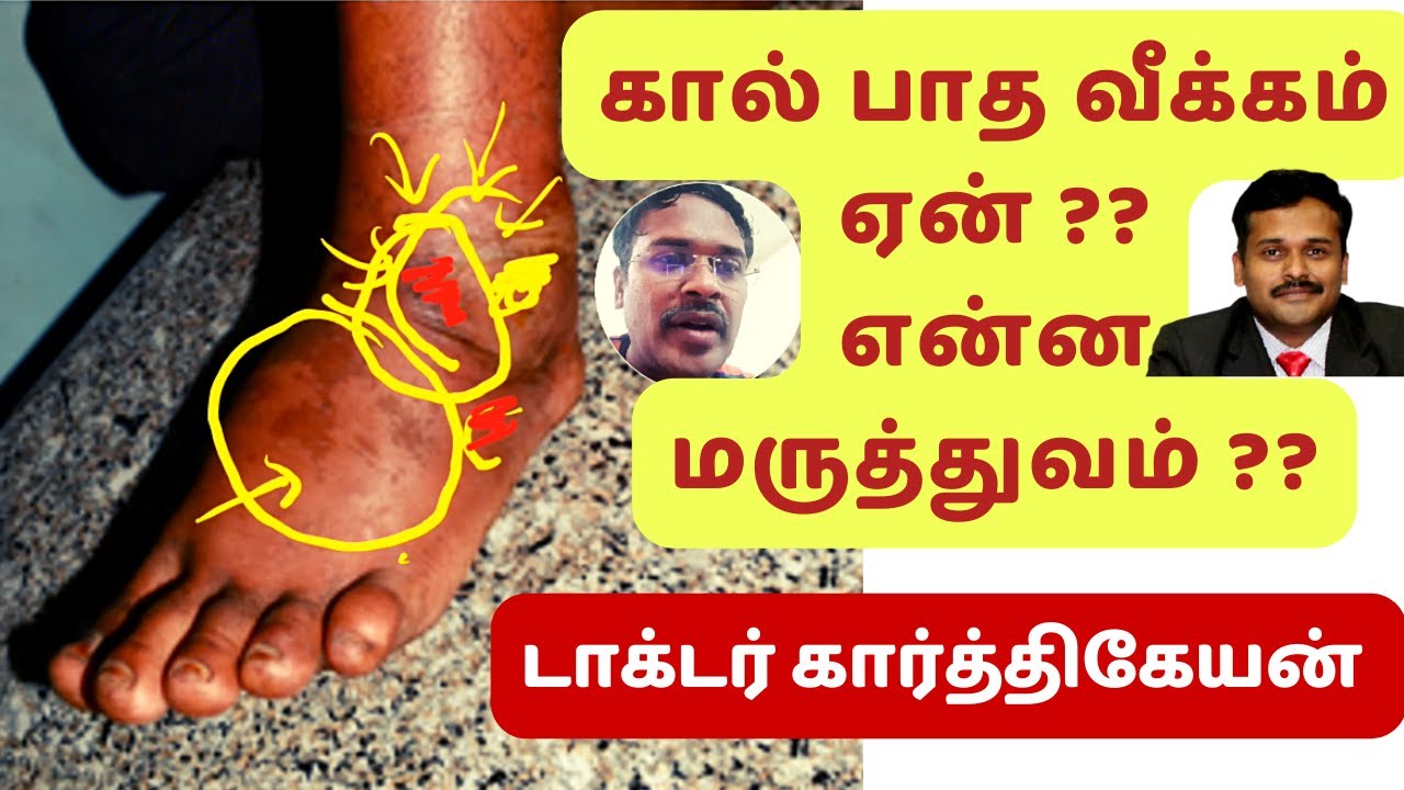 foot swelling treatment in tamil | dr karthikeyan-diabetes | கால் வீக்கம் எதனால் ஏற்படுகிறது
