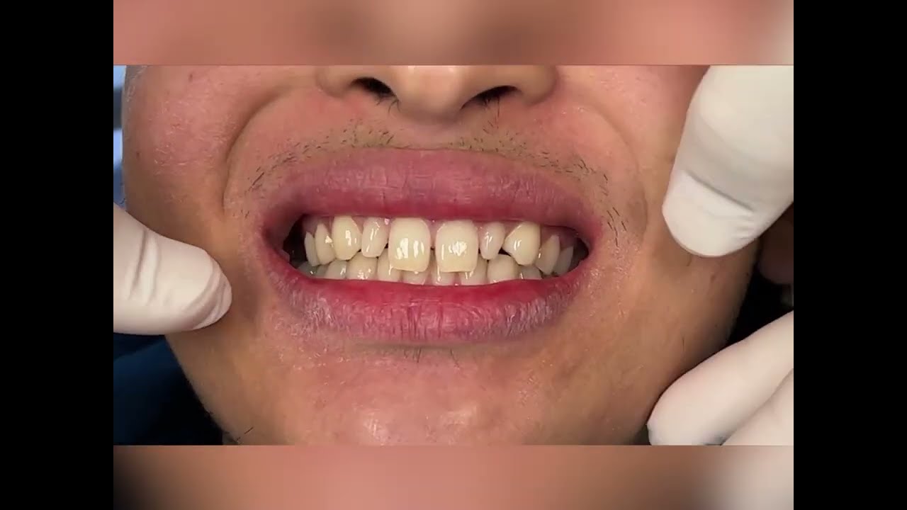 Veneer Test Drive