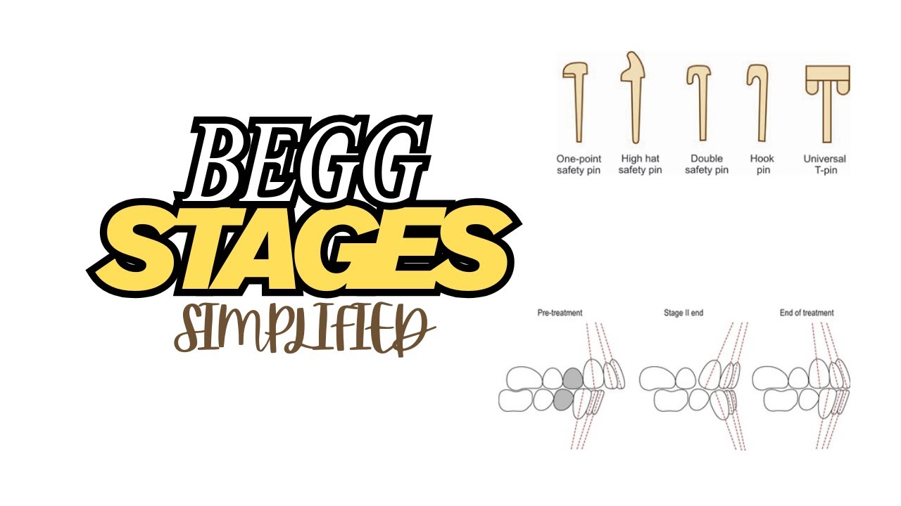 BEGG TECHNIQUE STAGES |An overview of stages of BEGG technique in Orthodontics|