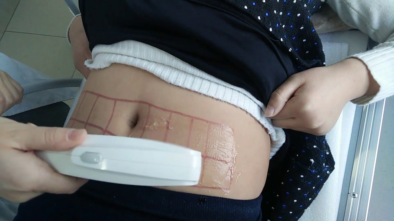 HIFU for treatment in stomach from Beijing Starlight Alice for body slimmming