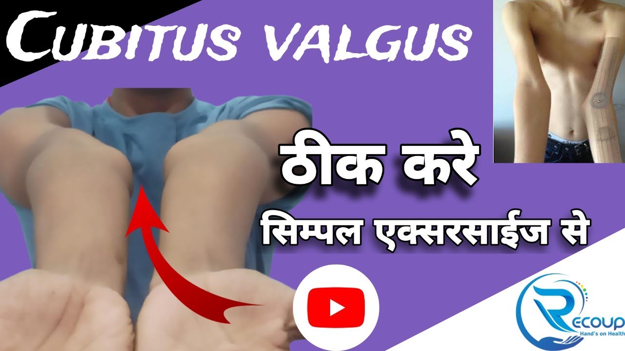 cubitus valgus treatment.carrying angle kese thik kare.#carryingangle #cubitusvalgus #army #physical