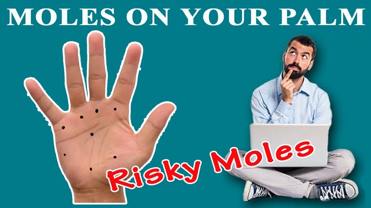 RISKY MOLES || KHUBAKTA SAMBRU THUNGBA || MOLES ON YOUR PALM || PALMISTRY