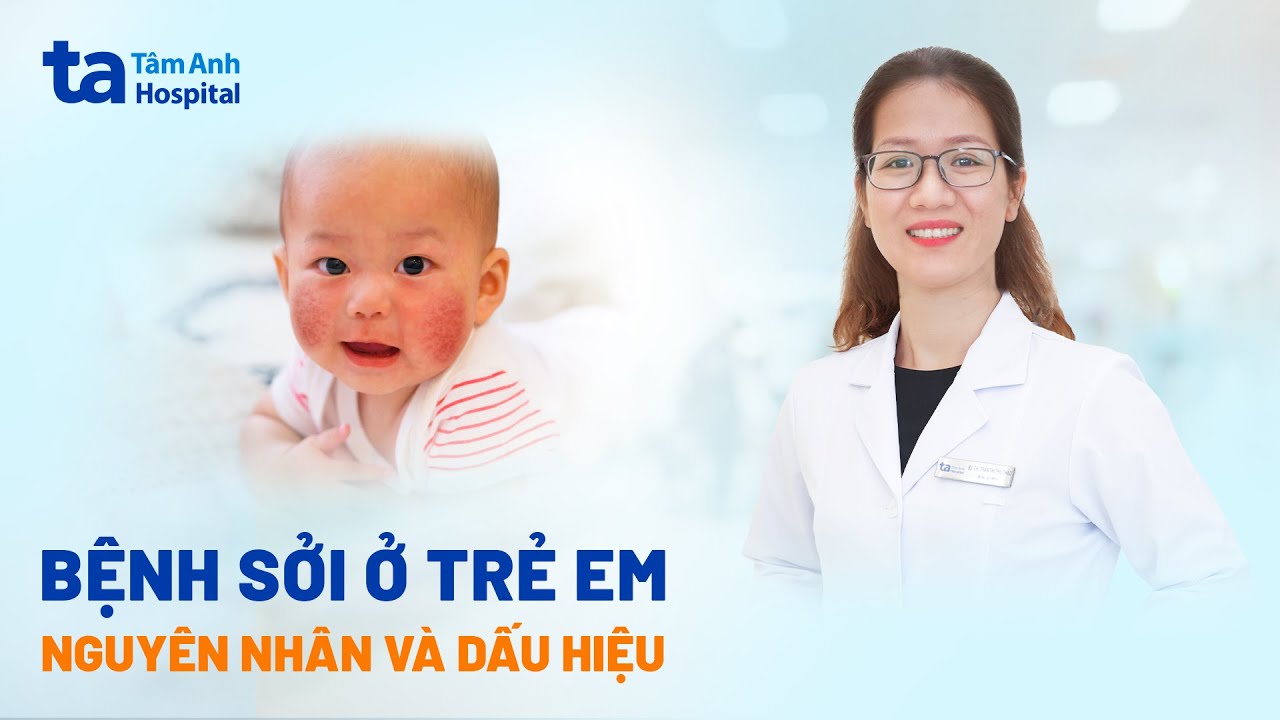 Bệnh sởi ở trẻ em là gì? Nguyên nhân, dấu hiệu và cách điều trị hiệu quả | BVĐK Tâm Anh