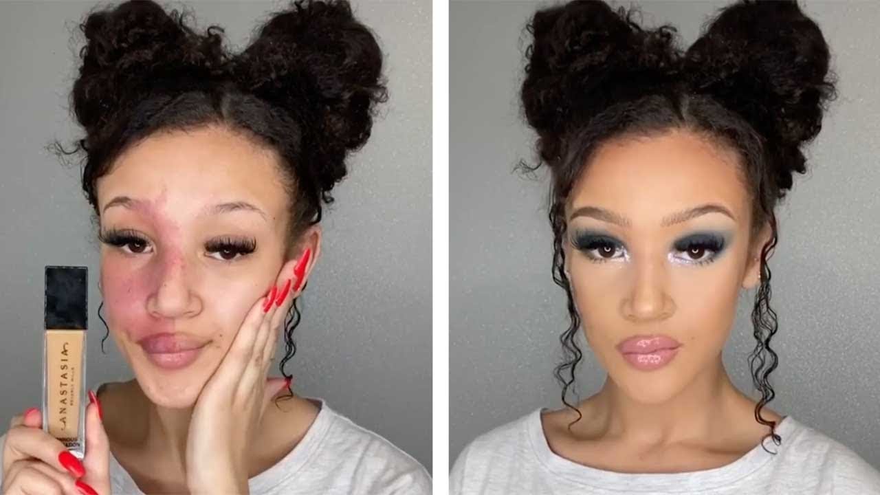 Teen With Birthmark Shows Off Stunning Transformations
