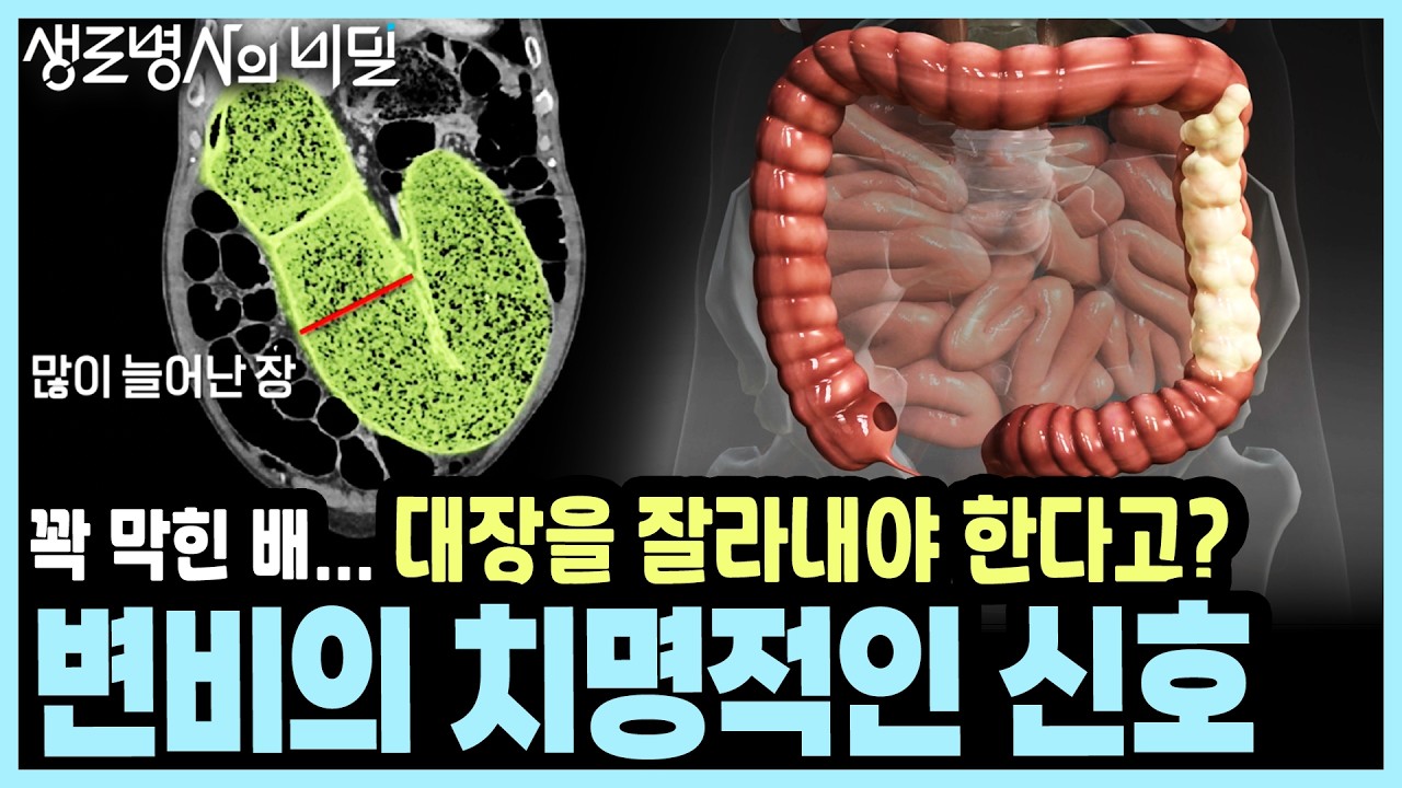 [본방종합] 똥독 오르면 죽는다? 진짜입니다! 가성 장폐색부터 사망 위험까지, 변비가 경고! I KBS 생로병사의 비밀 20260415 방송