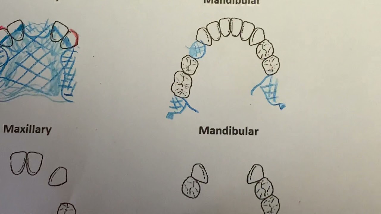 Cast Partial Denture Design Kennedy Class I