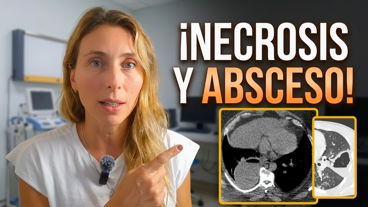 Absceso Pulmonar vs Neumonía Necrotizante | Tomografía