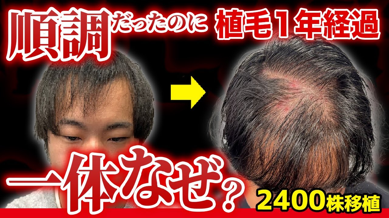 【衝撃の悲劇】植毛して1年経過したのにまさかの薄毛に逆戻り!?
