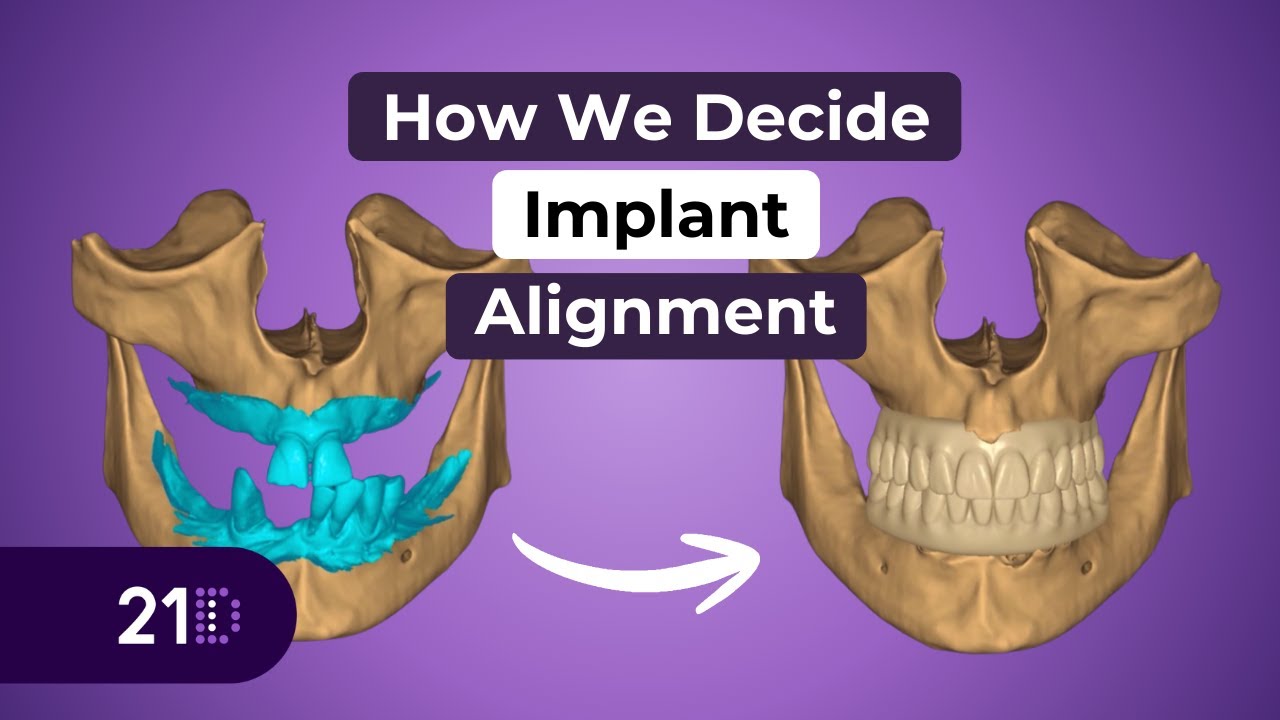 How We Decide Implant Alignment | Putting Longevity First