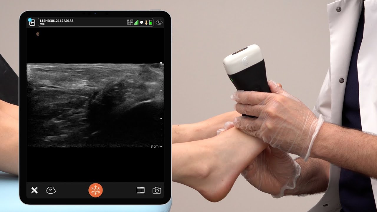 How to Assess for Morton's Neuroma