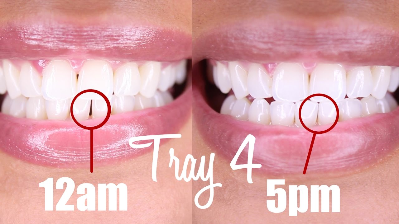 WK 9 (Clear Braces): Tray 3 Update + Tray 4 Try-on | SmileDirectClub | Kyma Monai