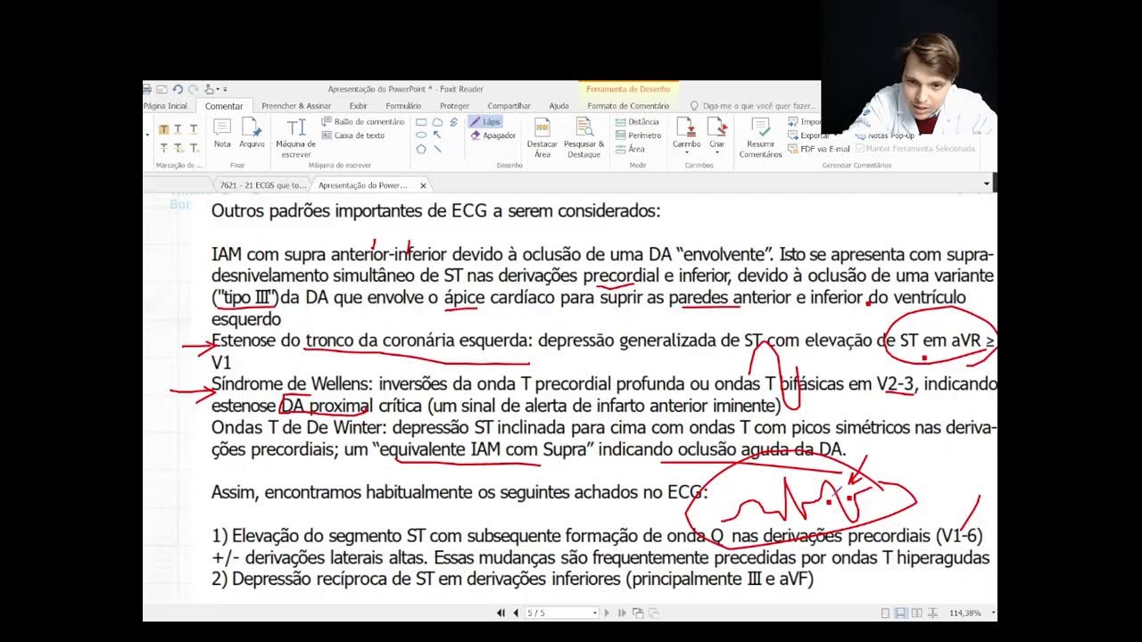 clinica do ecg - INFARTO de parede ANTERIOR - O QUE PRECISO SABER? Dr Thiago Barros -