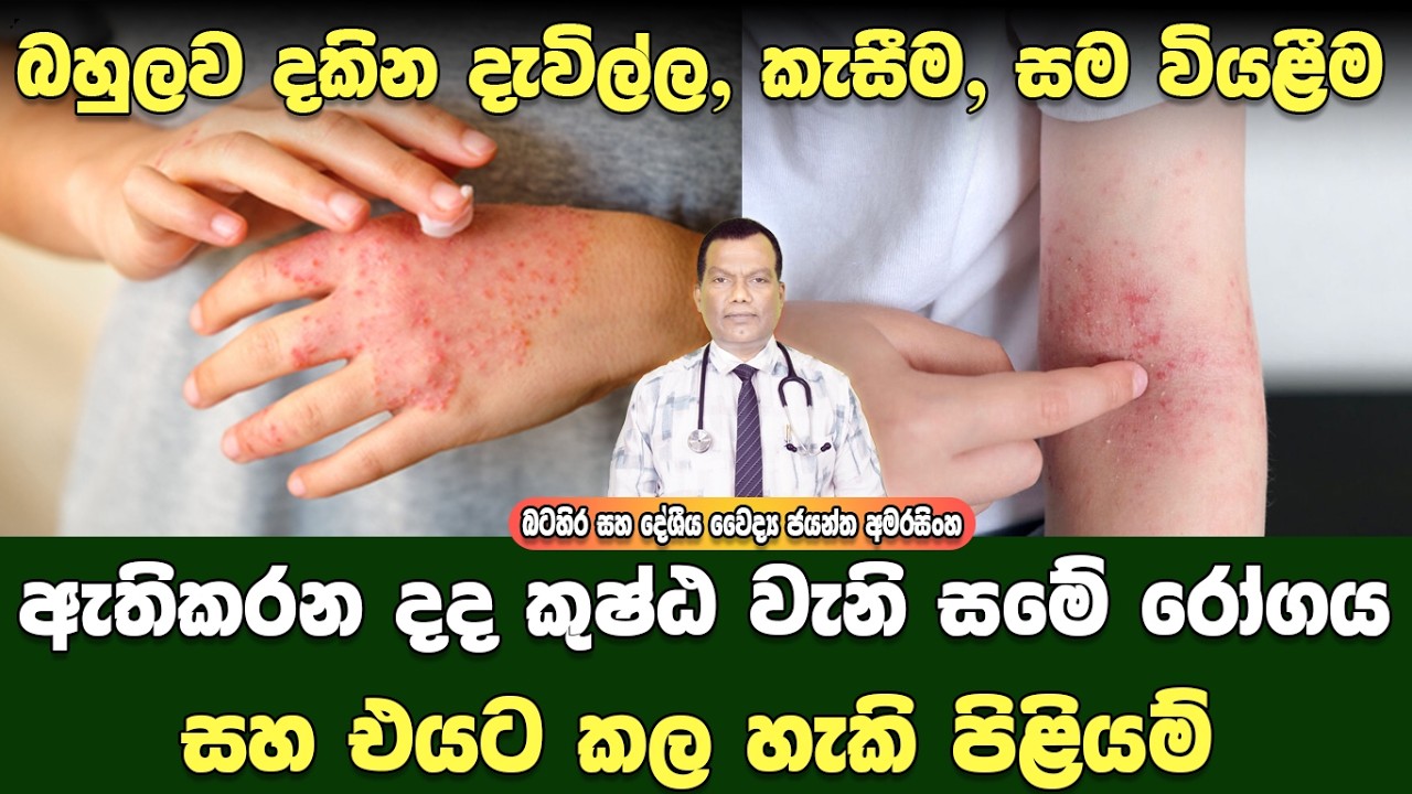 තවත් බහුලව ඇතිවන දැවිල්ල, කැසීම, සම වියළීම ඇතිකරන දද, කුෂ්ඨ වැනි සමේ රෝග තත්ත්වයක් Atopic Eczema