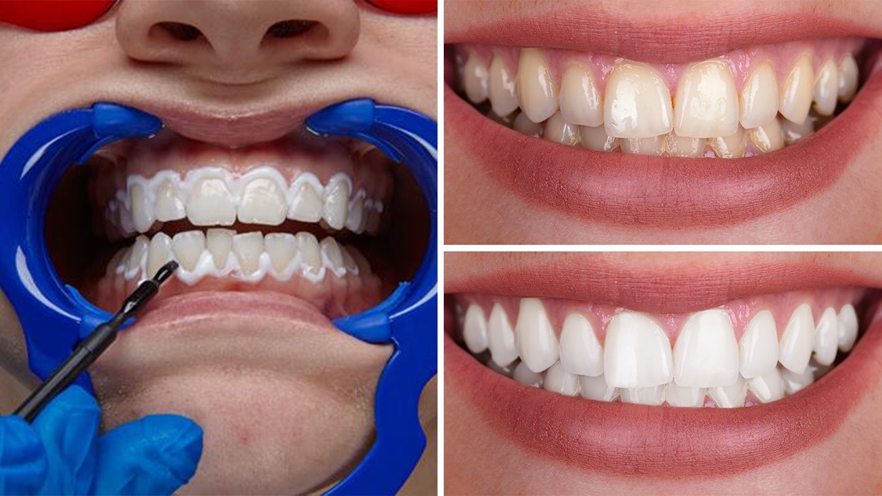 4 Best Ways To Whiten Your Teeth