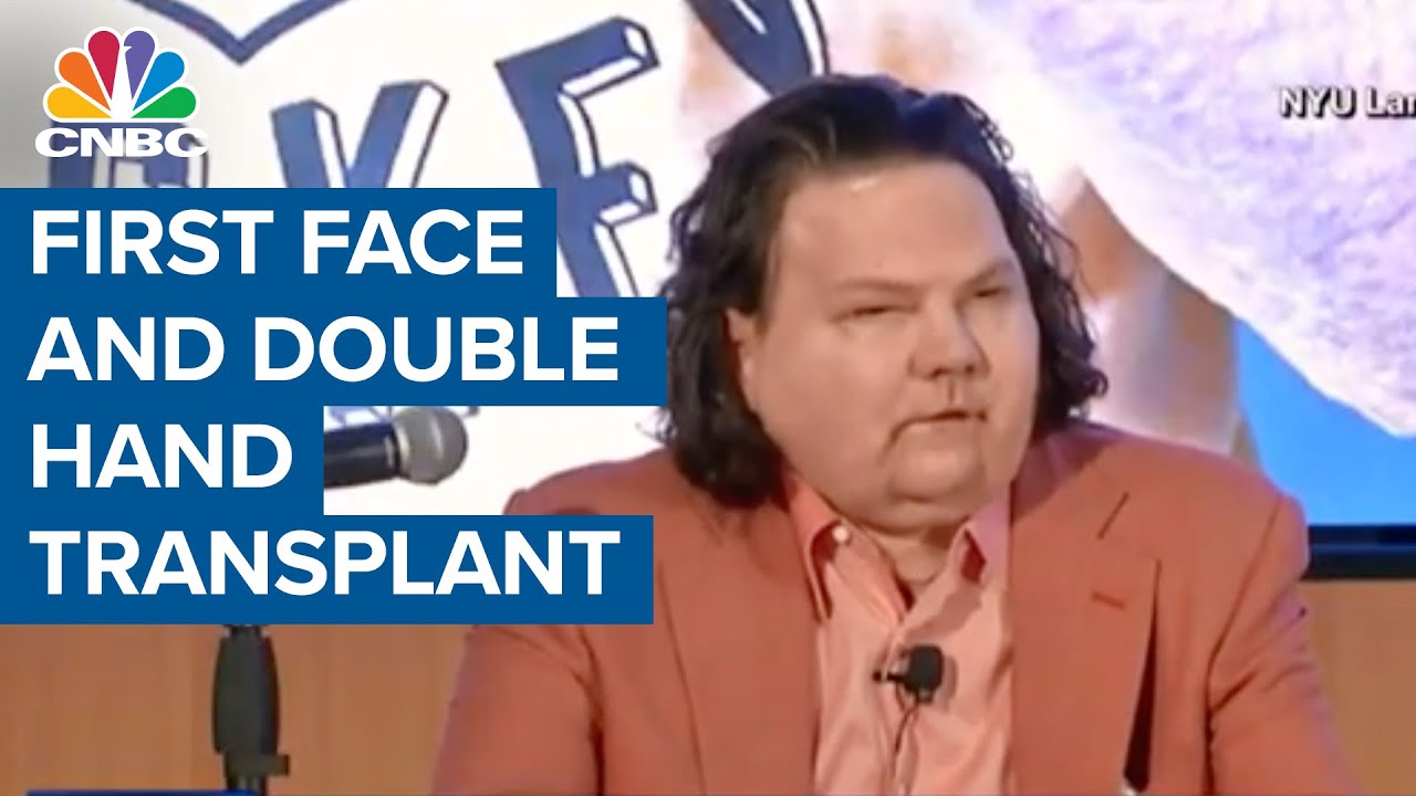 Burn victim receives first successful face and double hand transplant