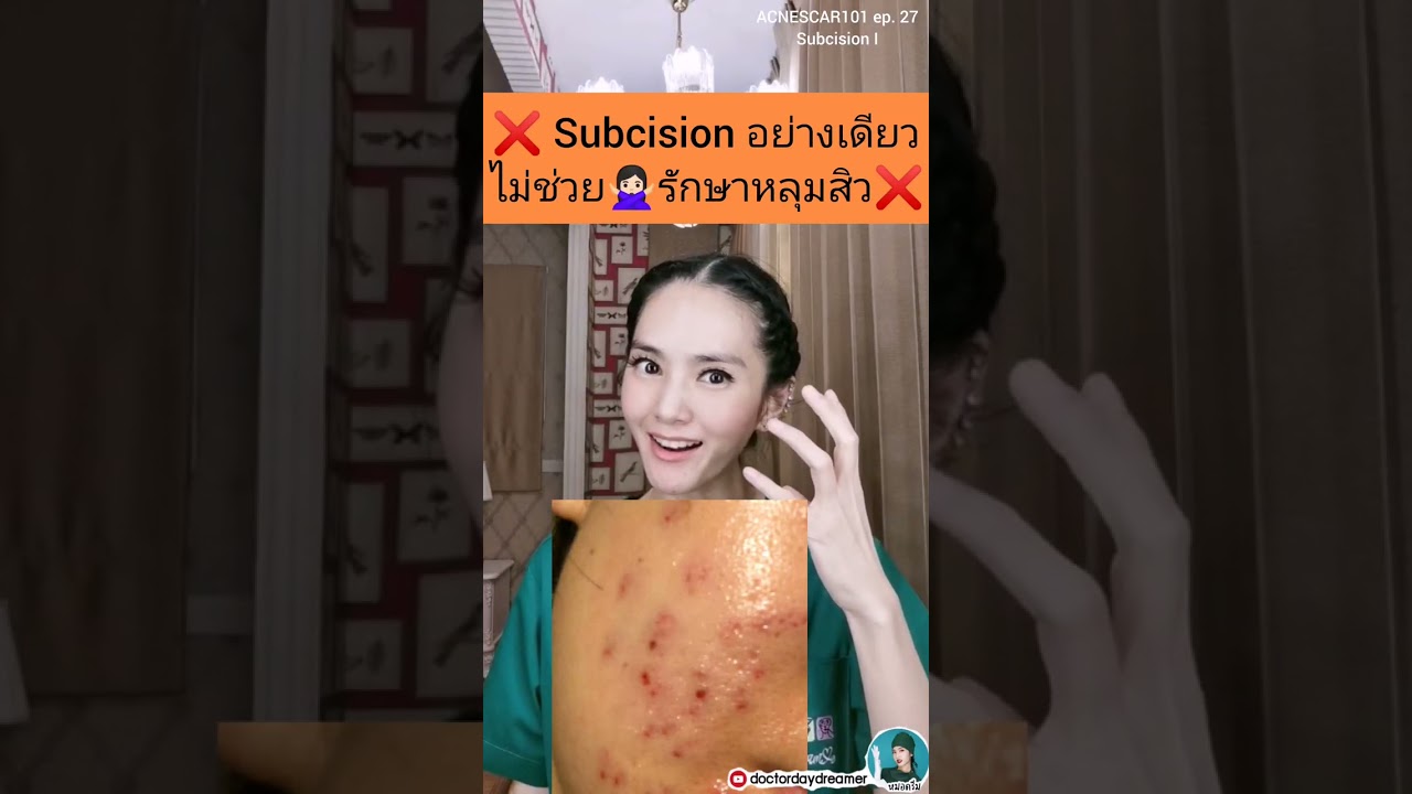 ❌subcision❌อย่างเดียวไม่ช่วย🙅🏻‍♀️ #หลุมสิว​ ⚠️ | DOCTOR DAYDREAMER #ACNESCAR101 ep.27 #subcision I