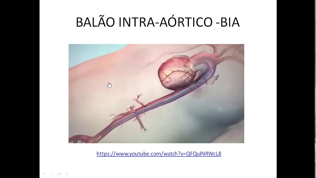BALÃO INTRA-AÓRTICO - BIA