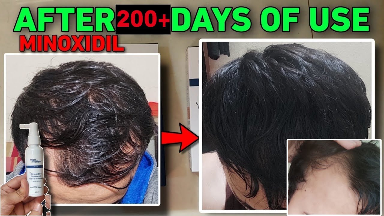 Minoxidil Long Term Review after 7 months HAIR FALL SOLUTION STOP HAIR FALL