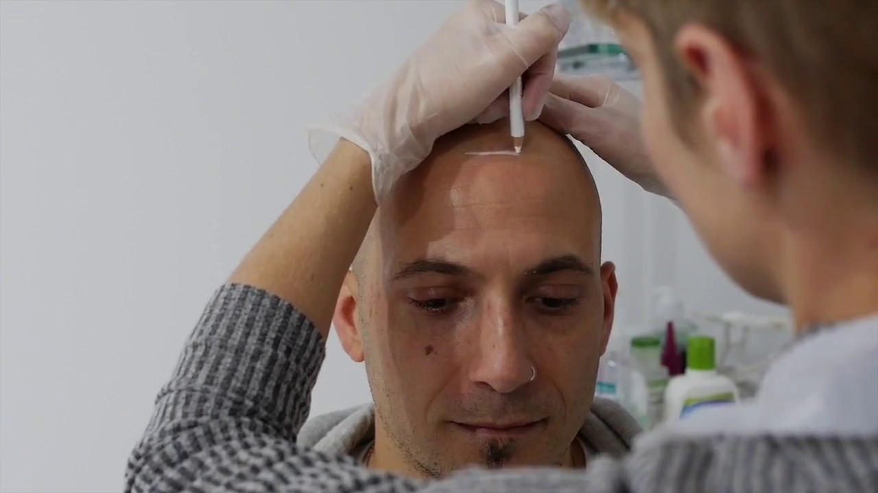 Scalp Micropigmentation | Hair Tattoo | SMP Clinic Sydney & Melbourne