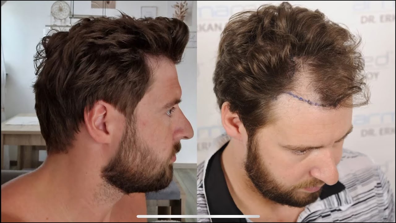 Dr.Erkan Demirsoy 3622 Grafts Fue Before After Photos 