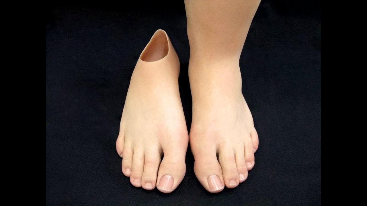 PARTIAL FOOT AMPUTATION
