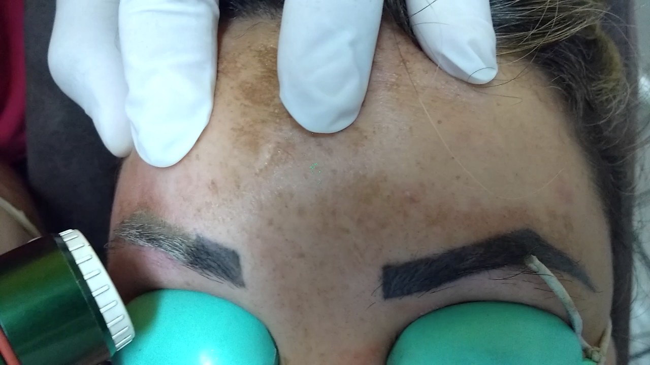 Despigmentação de Sobrancelhas