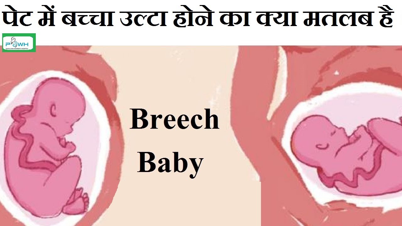 पेट में बच्चा उल्टा होने का क्या मतलब होता है? Breech Baby Meaning